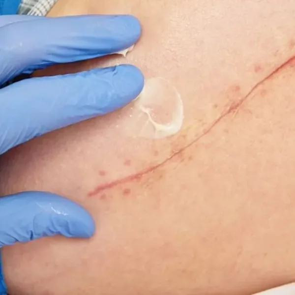 Mẹo để giảm sẹo sau phẫu thuật thẩm mỹ
