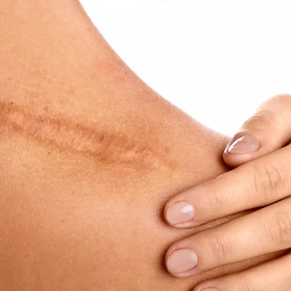 Các Phương Pháp Điều Trị Sẹo Hiệu Quả: Sản Phẩm Silicon, Tiêm Steroid và Laser