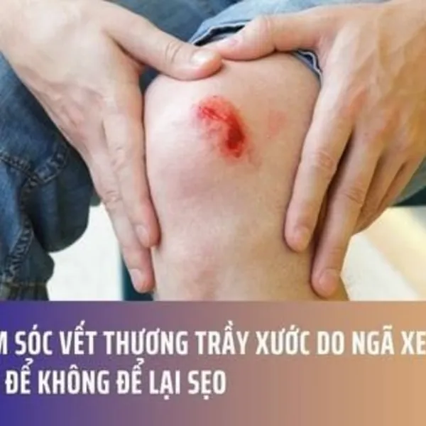 Chăm sóc vết thương trầy xước do ngã xe đúng cách để không để lại sẹo