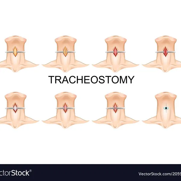 Chăm sóc vết thương (Lỗ) mở khí quản