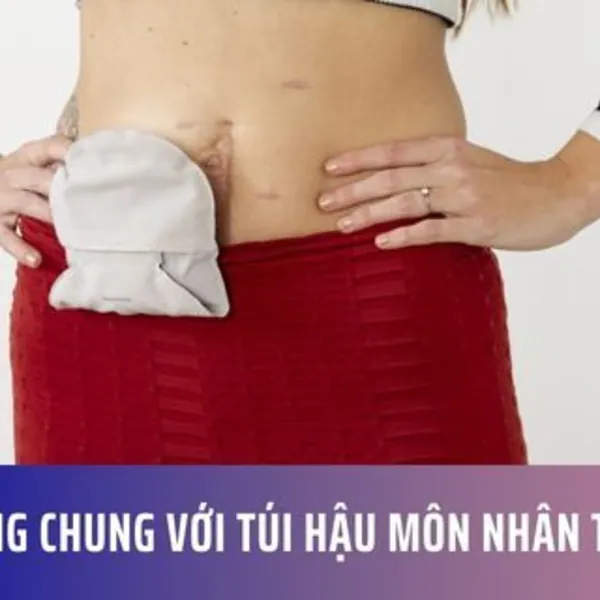 Sống chung với túi hậu môn nhân tạo
