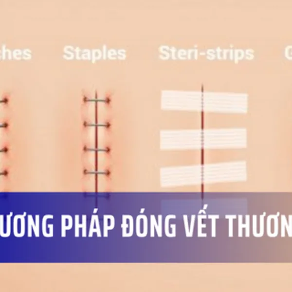 Mũi khâu, kim bấm, keo sinh học, khoá kéo vết thương: Trường hợp sử dụng