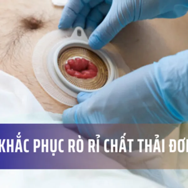 3 cách khắc phục rò rỉ hậu môn nhân tạo đơn giản ai cũng làm được