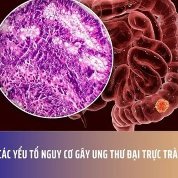 Các Yếu Tố Nguy Cơ Gây Ung Thư Đại Trực Tràng