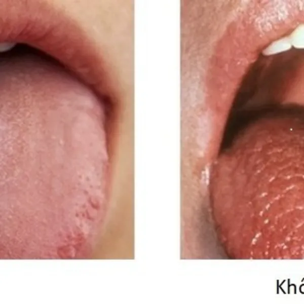 Khô miệng: Bạn không nên chủ quan