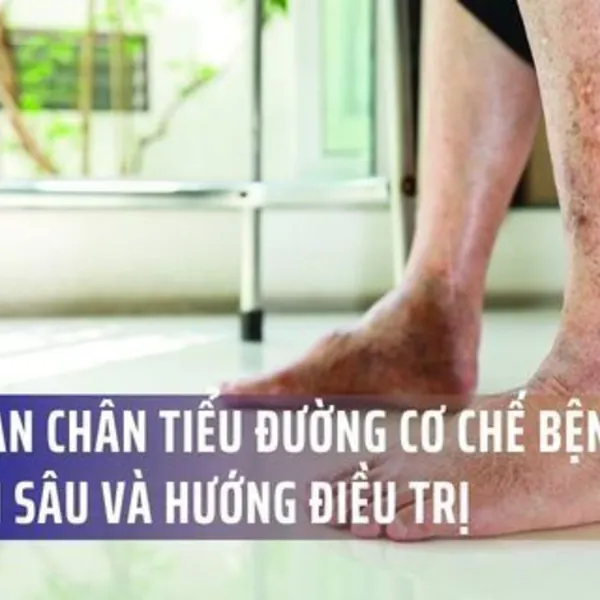 Loét bàn chân tiểu đường: Cơ chế bệnh sinh chuyên sâu và hướng điều trị mới nhất 2026