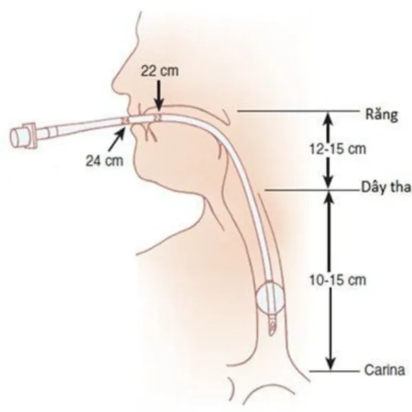 Đặt lại ống nội khí quản và nguy cơ viêm phổi so sánh với các nghiên cứu khác