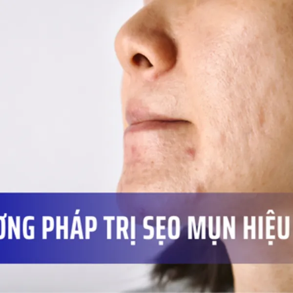 3 phương pháp trị sẹo mụn hiệu quả: Chiếu tia plasma, Lăn kim vi điểm, và Silicone gel