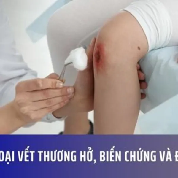 Phân loại vết thương hở, biến chứng và điều trị