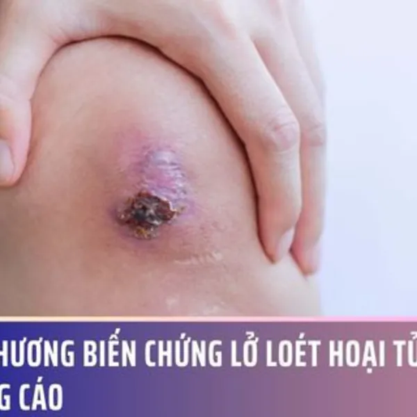 Vết thương biến chứng lở loét hoại tử vì lời quảng cáo