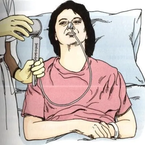 5 câu hỏi và quan niệm sai lầm hàng đầu về ống cho ăn
