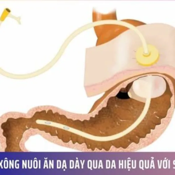 Quản lý Xông Nuôi Ăn Dạ Dày Qua Da Hiệu Quả với SeaSight