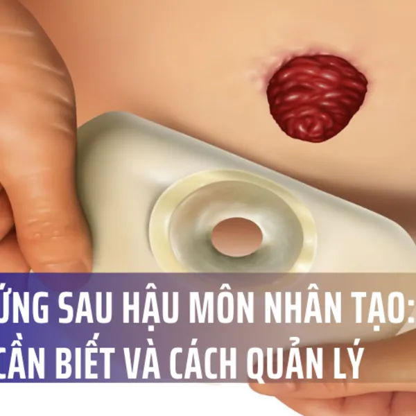 Biến Chứng Sau Hậu Môn Nhân Tạo: Các Vấn Đề Cần Biết và Cách Quản Lý