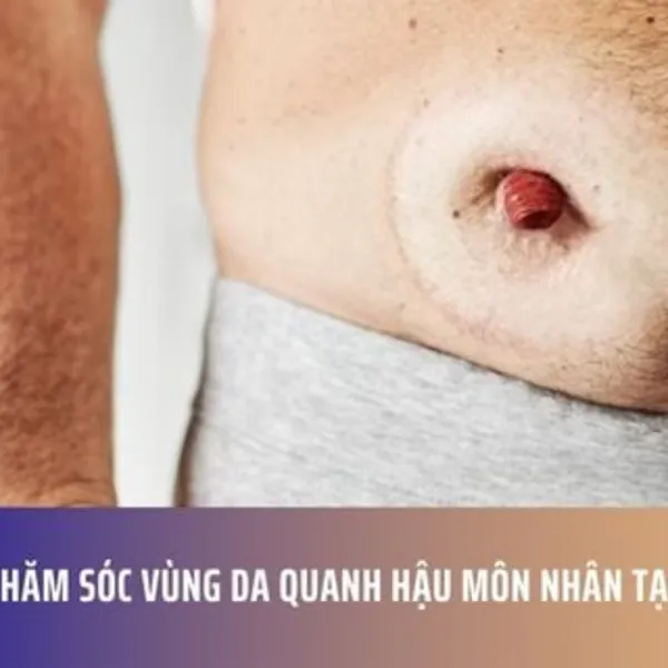 Chăm Sóc Vùng Da Quanh Hậu Môn Nhân Tạo