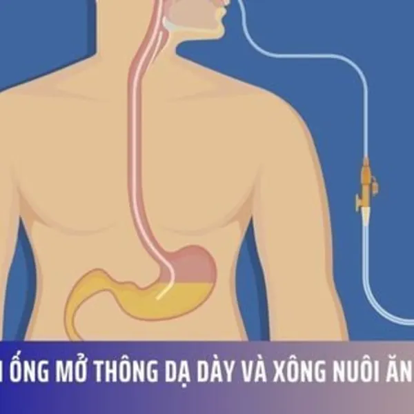 Lựa Chọn Ống Mở Thông Dạ Dày và Xông Nuôi Ăn Phù Hợp