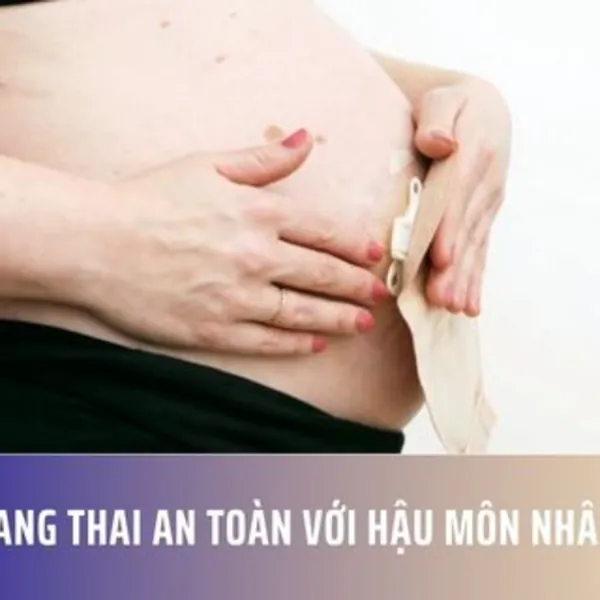 Mang thai an toàn với hậu môn nhân tạo