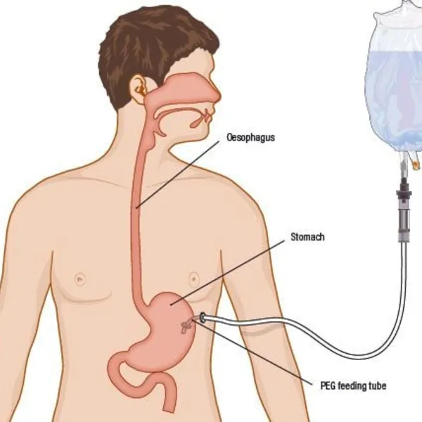 Đặt ống mở dạ dày qua da PEG và cách chăm sóc