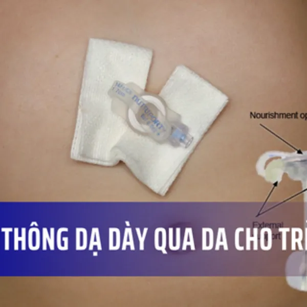 Ống mở thông dạ dày qua da cho trẻ (G-button)