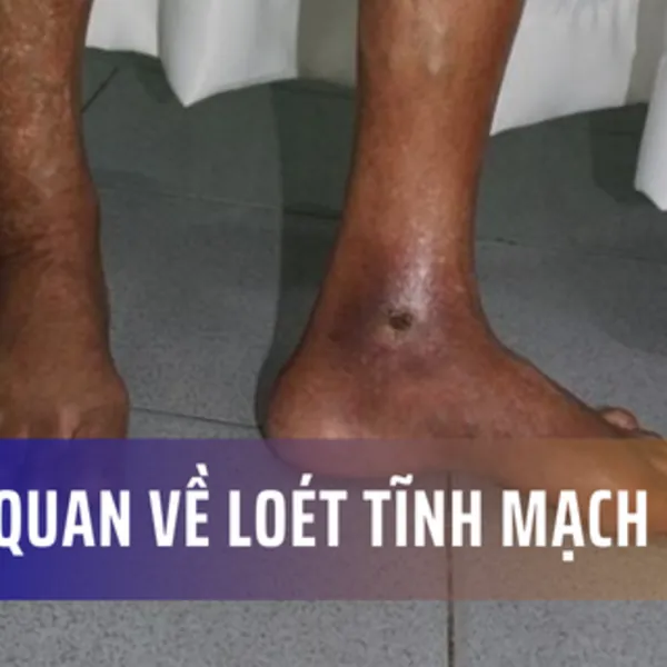 Tổng quan về loét do suy giãn tĩnh mạch
