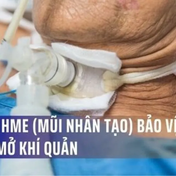 Cơ Chế HME (Mũi Nhân Tạo) Bảo Vệ Bệnh Nhân Mở Khí Quản