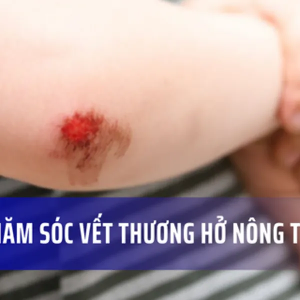 Cách chăm sóc vết thương hở và vết cắt nông tại nhà