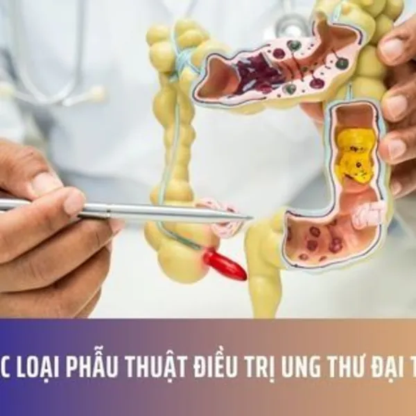 Các loại phẫu thuật điều trị ung thư đại tràng