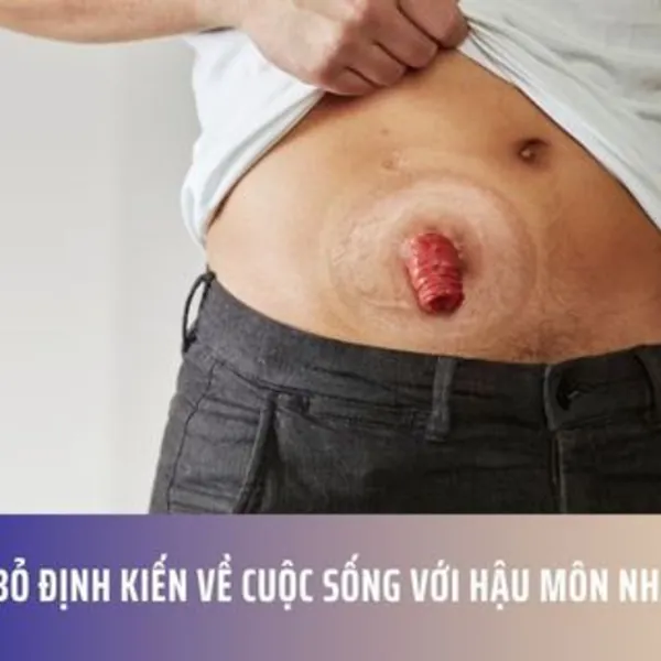 Xóa bỏ định kiến về cuộc sống với hậu môn nhân tạo