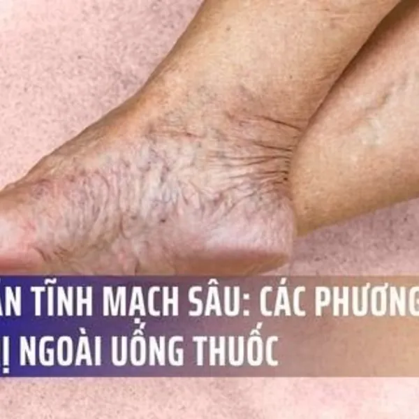 Suy Giãn Tĩnh Mạch Sâu: Các Phương Pháp Điều Trị Ngoài Uống Thuốc