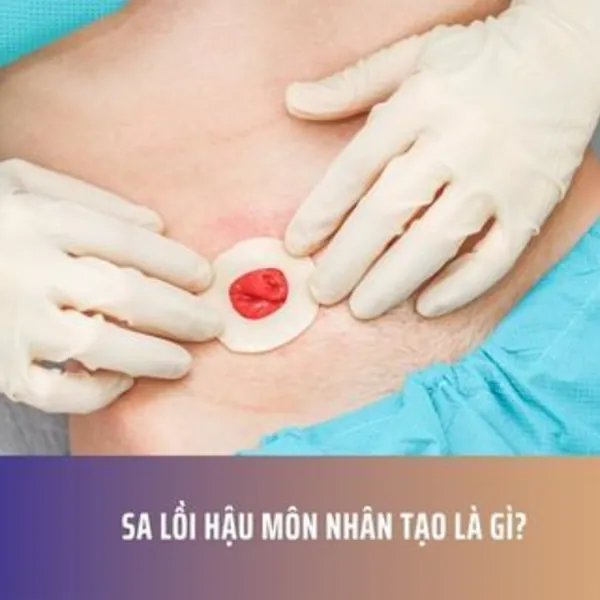 Sa lồi hậu môn nhân tạo là gì?