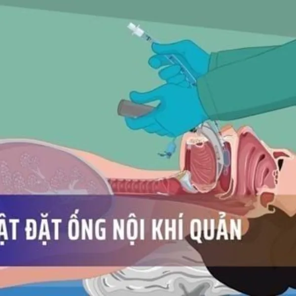 Kỹ Thuật Đặt Ống Nội Khí Quản
