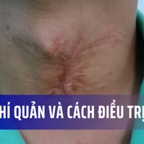 Hẹp khí quản và Cách điều trị