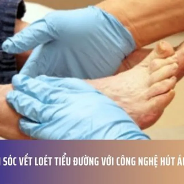 Chăm Sóc Vết Loét Tiểu Đường với Công Nghệ Hút Áp Lực Âm