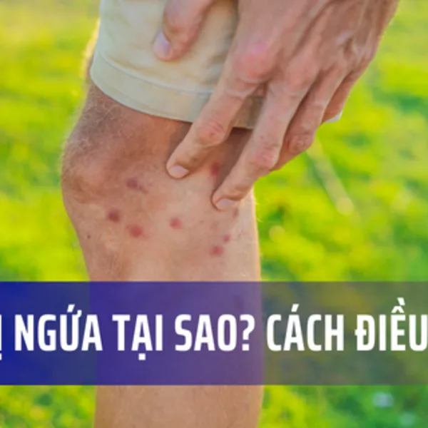 Vết sẹo bị ngứa tại sao? Cách trị sẹo ngứa hiệu quả