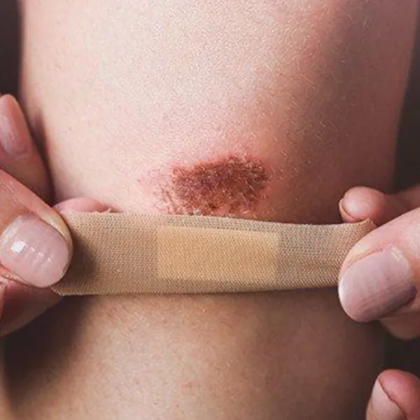 Hoại tử và bệnh tiểu đường: Những điều cần biết