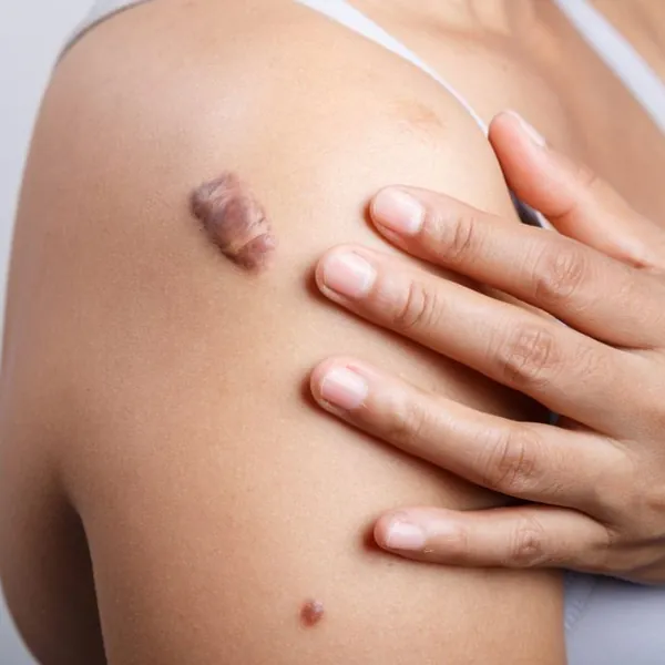 Cách ngăn ngừa và điều trị sẹo