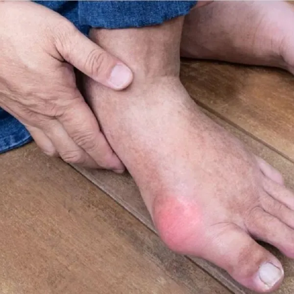 Xét nghiệm axit uric trong máu là gì?