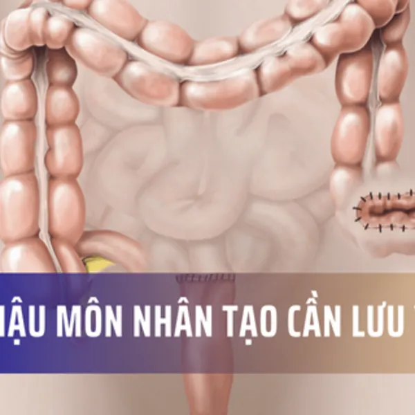 Phẫu thuật đóng hậu môn nhân tạo, cần lưu ý gì?