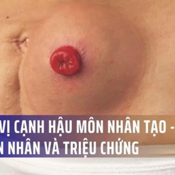 Nguyên nhân và nguy cơ xảy ra thoát vị cạnh hậu môn nhân tạo