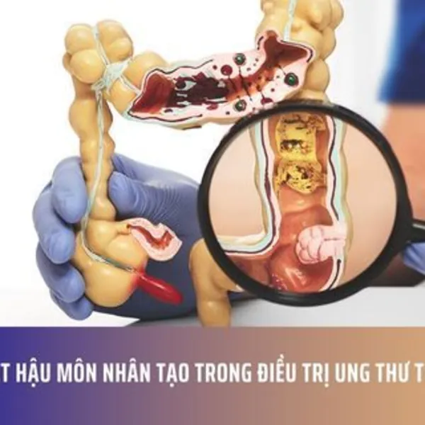 Phẫu thuật hậu môn nhân tạo trong điều trị ung thư trực tràng
