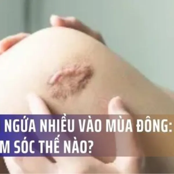 Sẹo lồi ngứa nhiều vào mùa đông: Vì sao và chăm sóc thế nào?