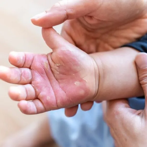 Nguyên nhân bỏng gây ra sẹo và sẹo bỏng được điều trị như thế nào?