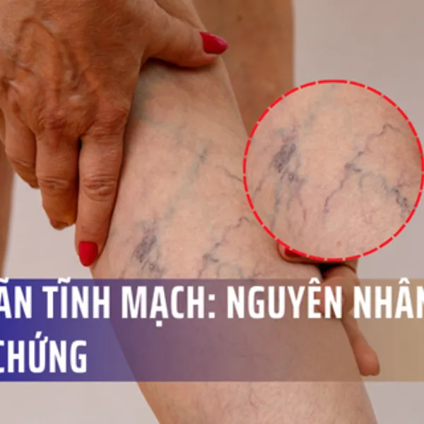 Suy giãn tĩnh mạch là gì? Nguyên nhân và Triệu chứng