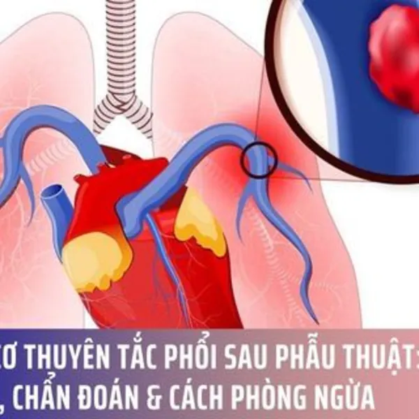 Thuyên tắc phổi sau phẫu thuật: triệu chứng, chẩn đoán và điều trị