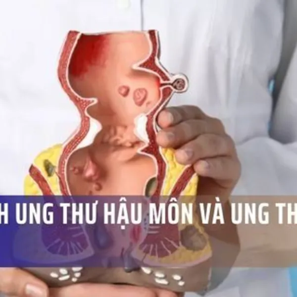 So sánh Ung thư Hậu môn và Ung thư Trực tràng: Triệu chứng, Nguyên nhân, Điều trị và Tiên lượng