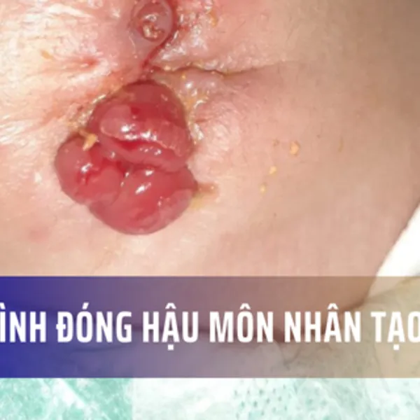 Quy trình đóng hậu môn nhân tạo ở trẻ em
