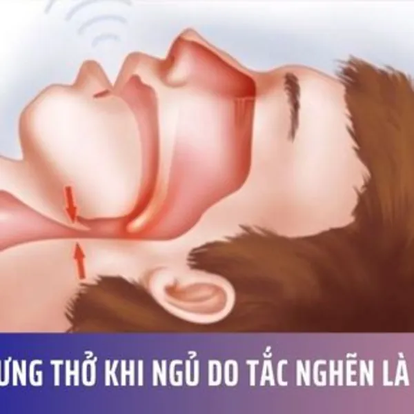 Ngưng thở khi ngủ do tắc nghẽn là gì?
