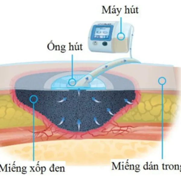 Chăm sóc Vết thương bằng Liệu pháp hút áp lực âm VAC