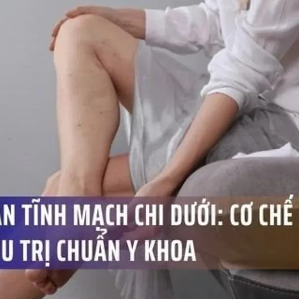 Suy Giãn Tĩnh Mạch Chi Dưới: Từ Cơ Chế Sinh Lý Bệnh Đến Nguyên Lý Điều Trị Chuẩn Y Khoa