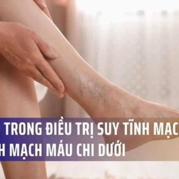 Tiến Bộ Trong Điều Trị Suy Tĩnh Mạch Chân Và Bệnh Mạch Máu Chi Dưới