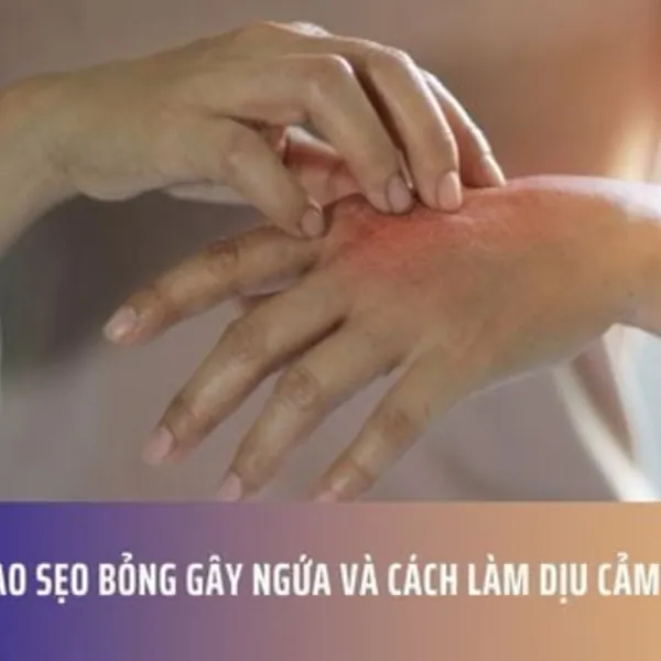 Tại Sao Sẹo Bỏng Gây Ngứa Và Cách Làm Dịu Cảm Giác Đó